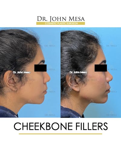 Cheekbone Filler Before & After Gallery - Patient 862796 - Image 4
