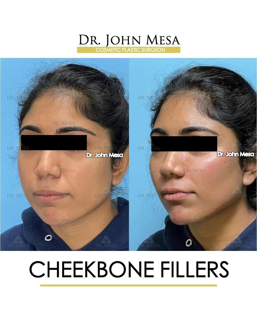 Cheekbone Filler Before & After Gallery - Patient 862796 - Image 5