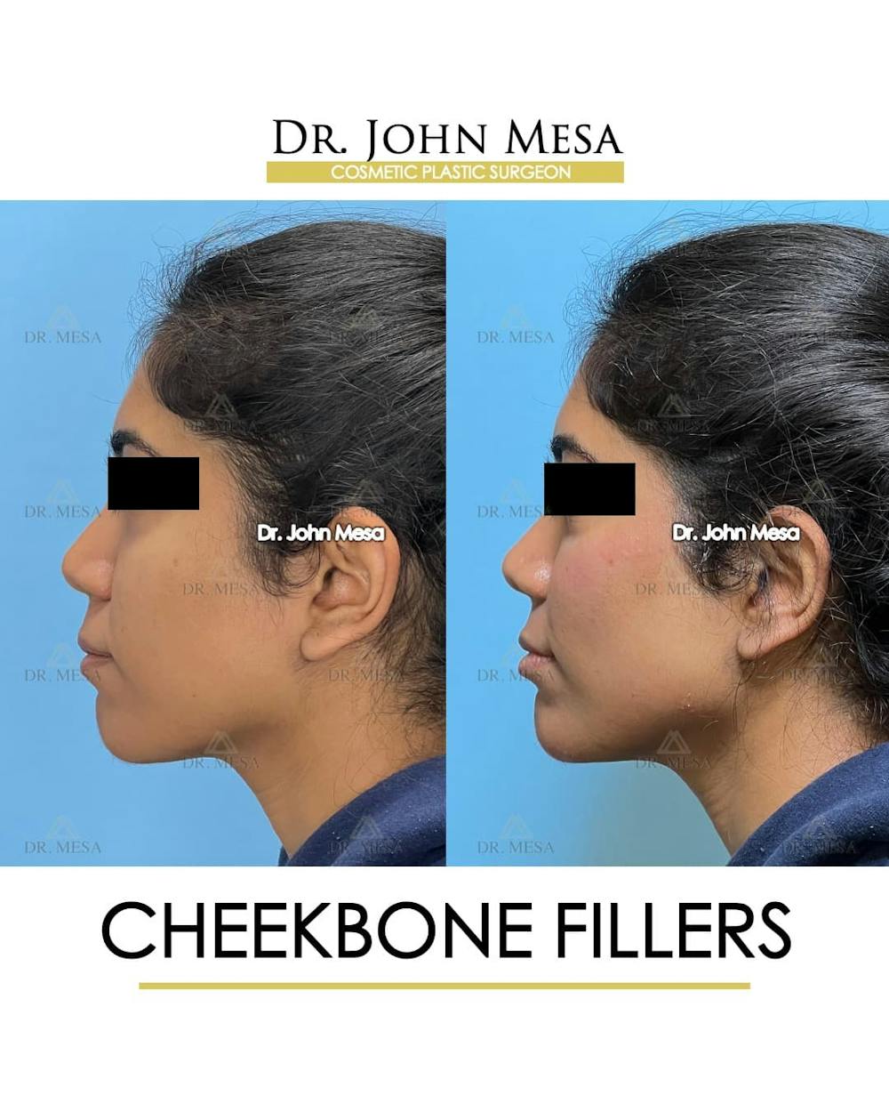 Cheekbone Filler Before & After Gallery - Patient 862796 - Image 6