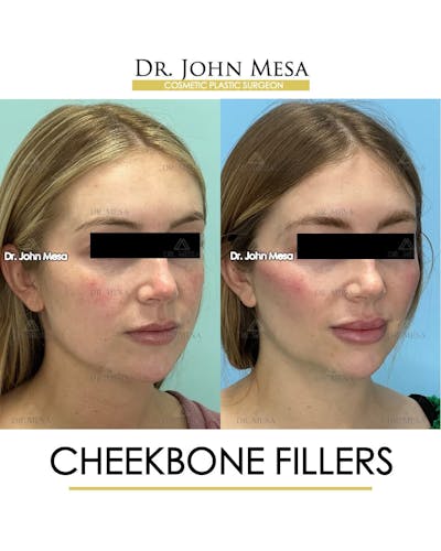 Cheekbone Filler Before & After Gallery - Patient 329931 - Image 2