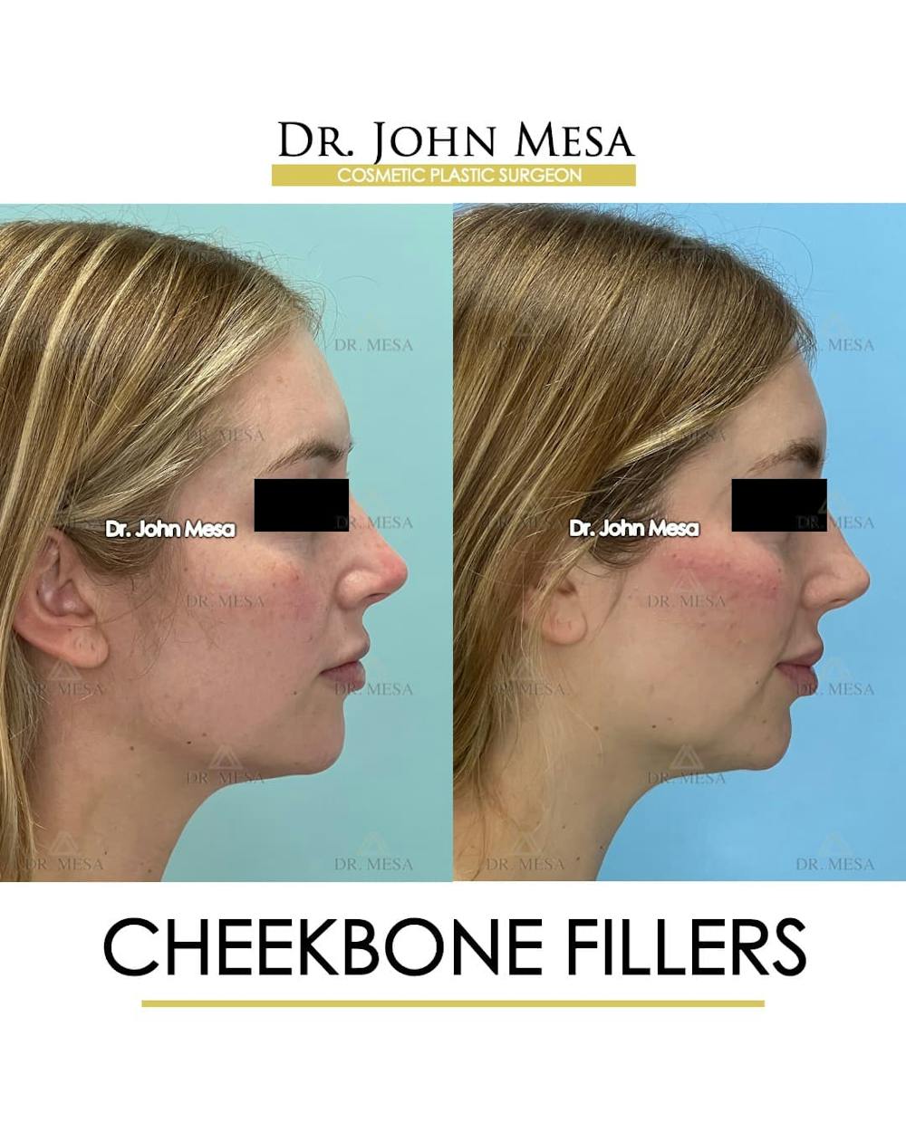 Cheekbone Filler Before & After Gallery - Patient 329931 - Image 3