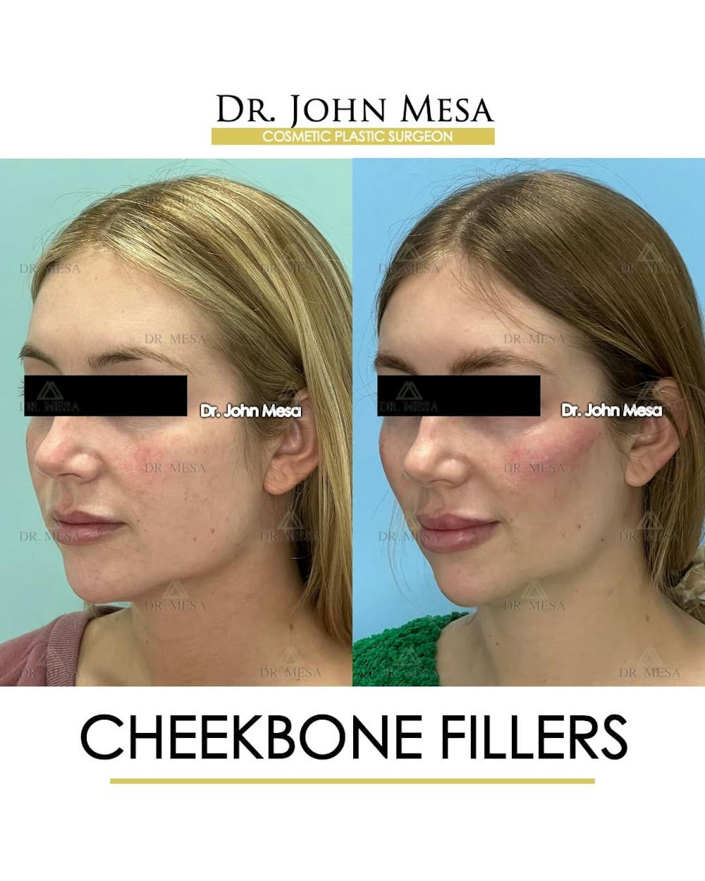 Cheekbone Filler Before & After Gallery - Patient 329931 - Image 4