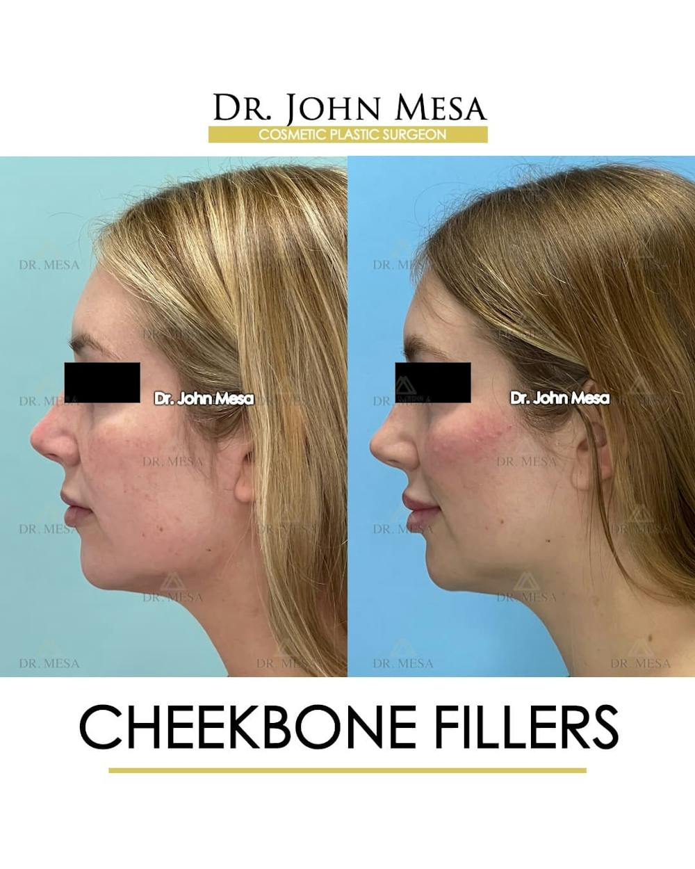 Cheekbone Filler Before & After Gallery - Patient 329931 - Image 5