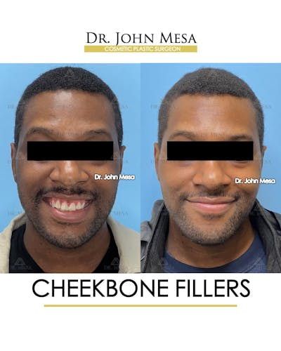 Cheekbone Filler Before & After Gallery - Patient 113394 - Image 2