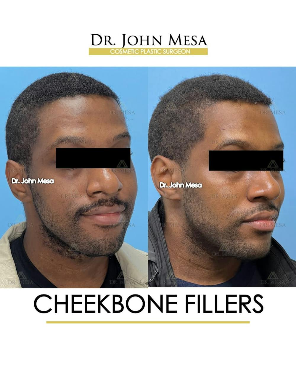 Cheekbone Filler Before & After Gallery - Patient 113394 - Image 3