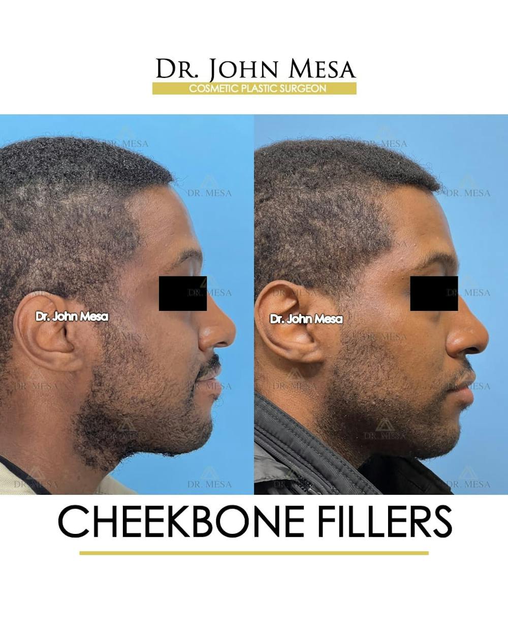 Cheekbone Filler Before & After Gallery - Patient 113394 - Image 4