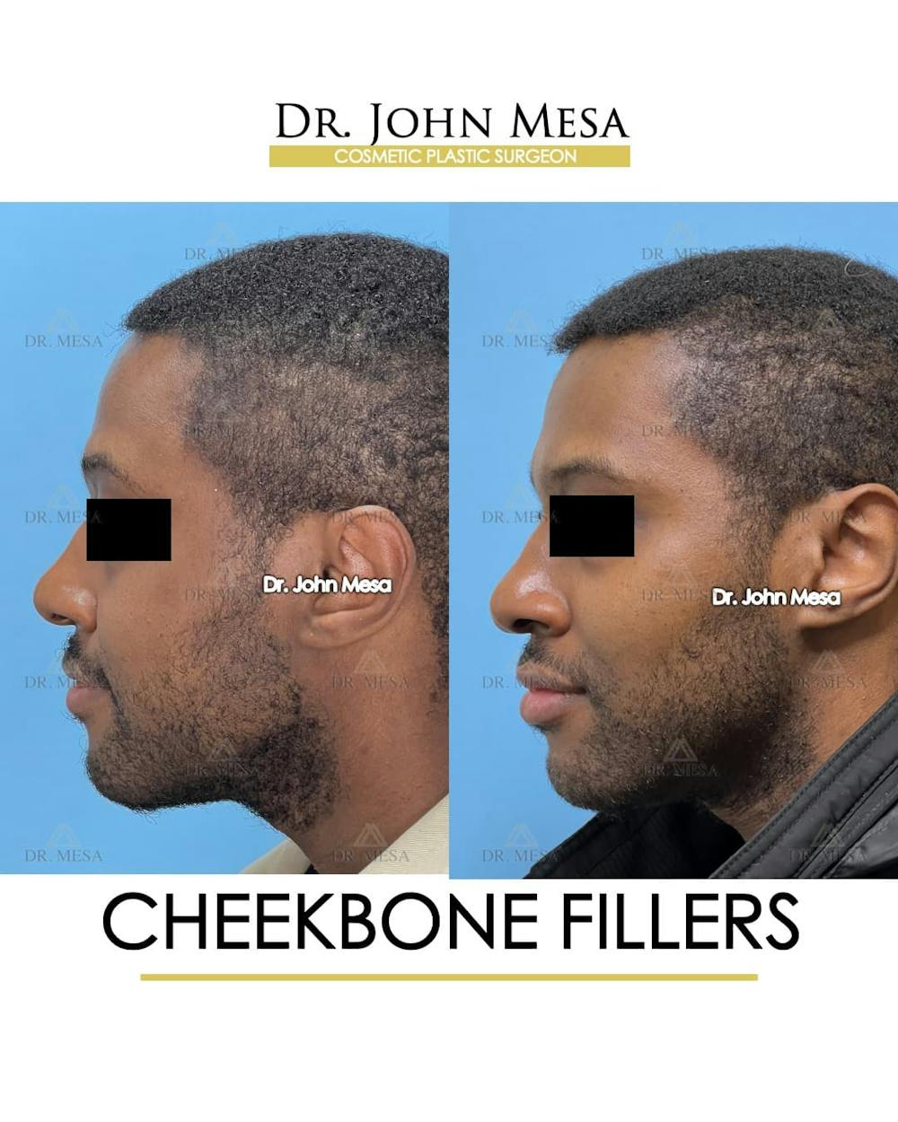 Cheekbone Filler Before & After Gallery - Patient 113394 - Image 5