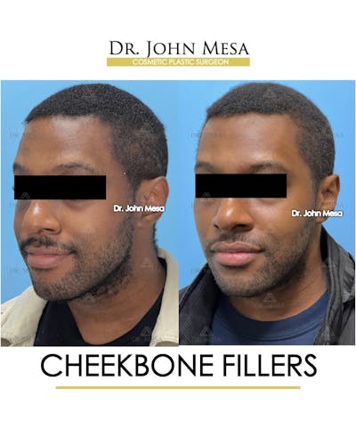 Cheekbone Filler Before & After Gallery - Patient 113394 - Image 6
