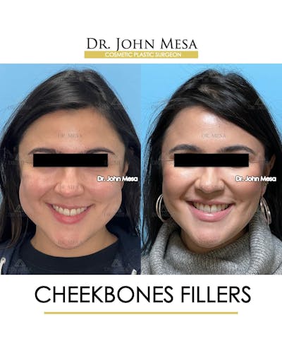 Cheekbone Filler Before & After Gallery - Patient 406114 - Image 2
