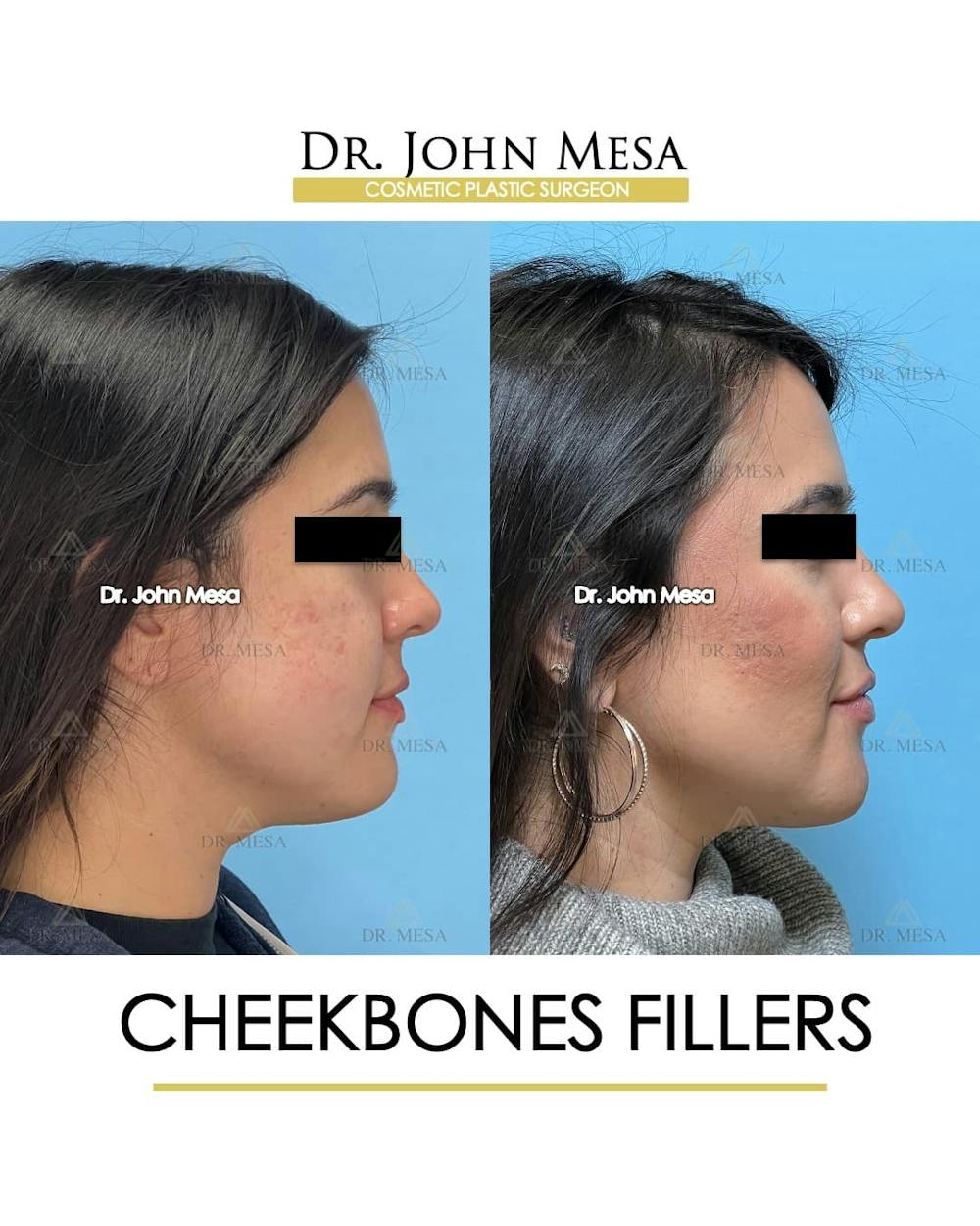 Cheekbone Filler Before & After Gallery - Patient 406114 - Image 4