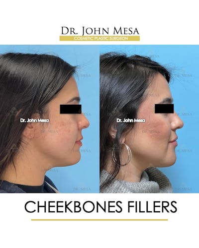 Cheekbone Filler Before & After Gallery - Patient 406114 - Image 4