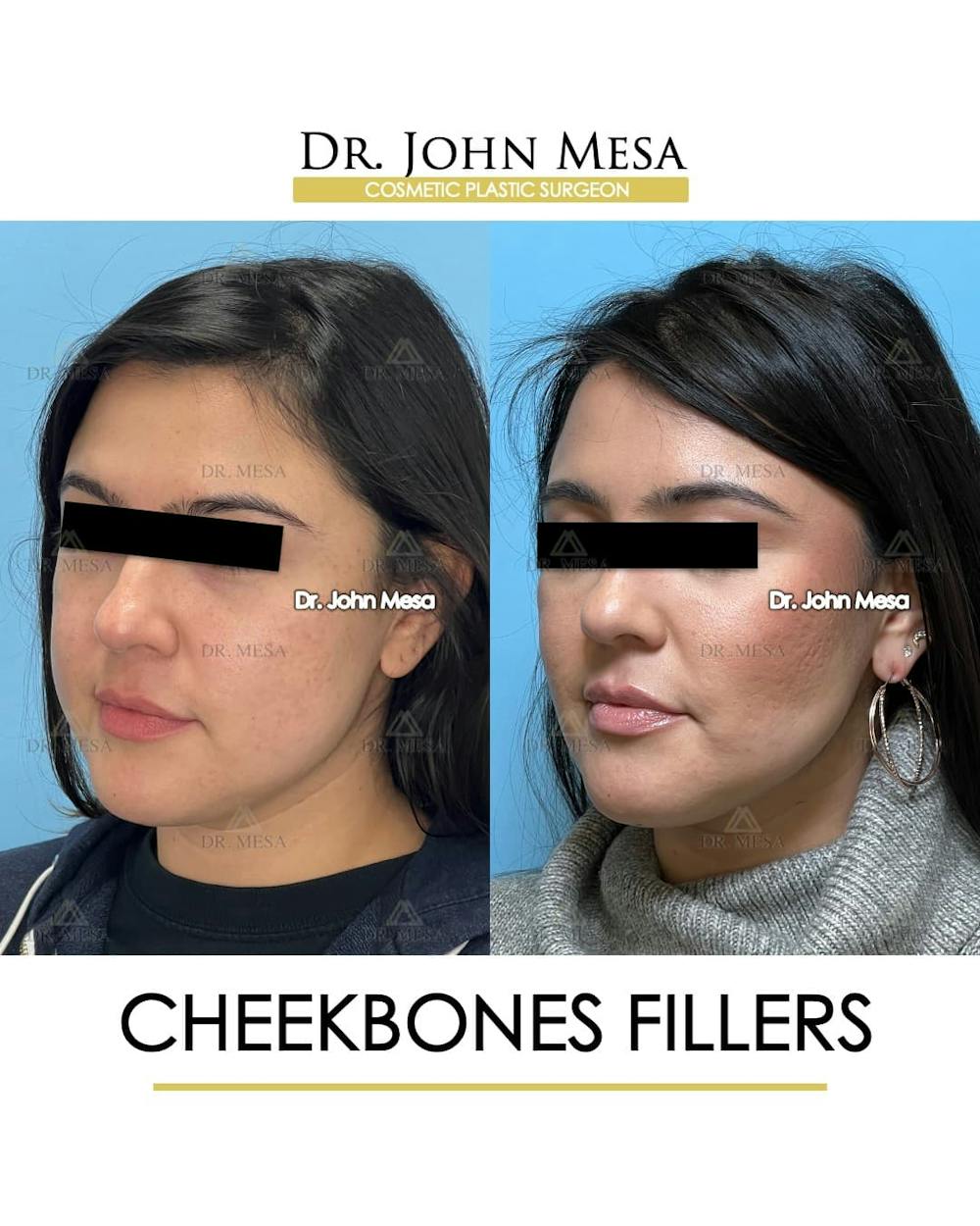 Cheekbone Filler Before & After Gallery - Patient 406114 - Image 5