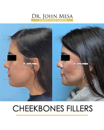 Cheekbone Filler Before & After Gallery - Patient 406114 - Image 6