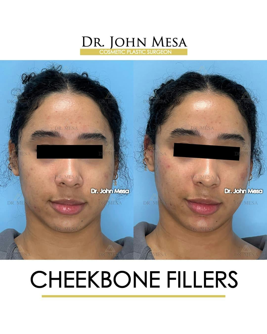 Cheekbone Filler Before & After Photos | Dr. Mesa