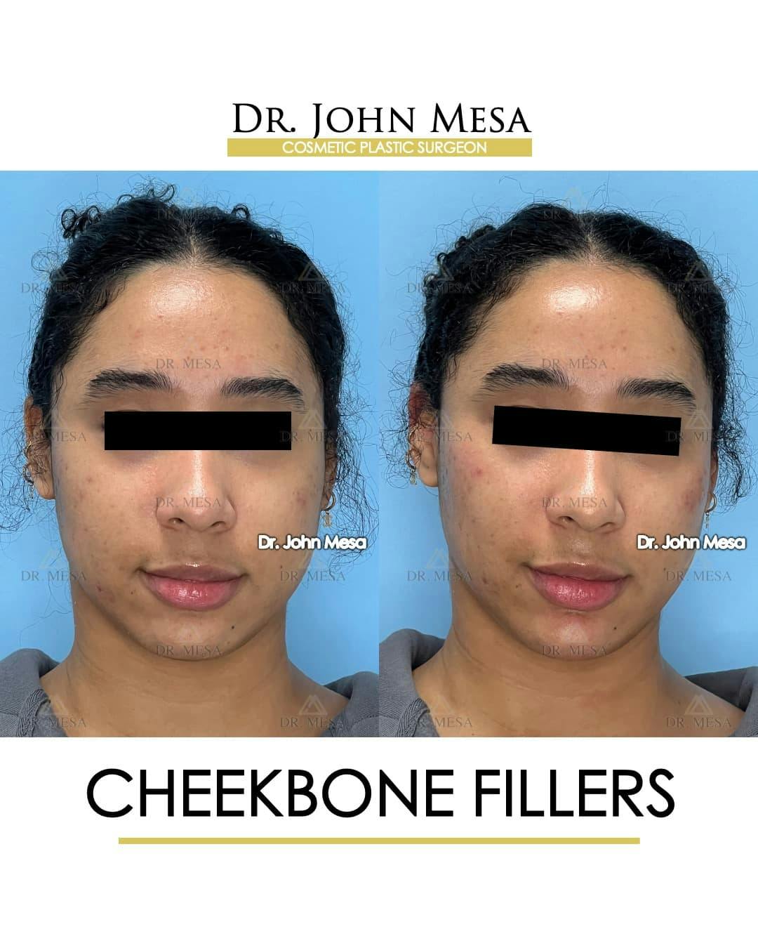 Cheekbone Filler Before & After Gallery - Patient 147931 - Image 1