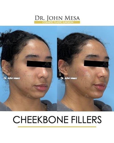 Cheekbone Filler Before & After Gallery - Patient 147931 - Image 2