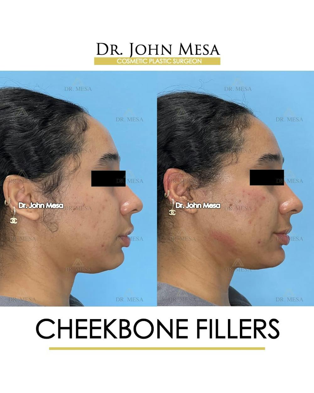 Cheekbone Filler Before & After Gallery - Patient 147931 - Image 3