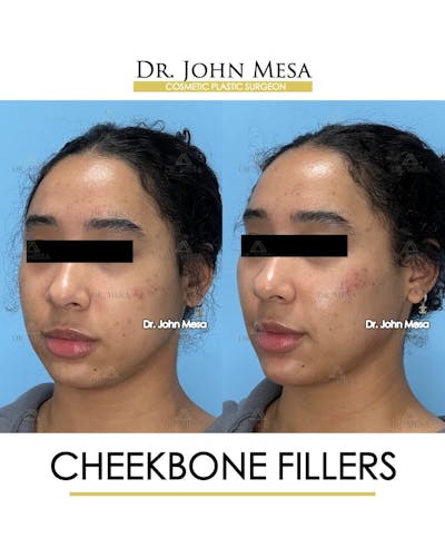 Cheekbone Filler Before & After Gallery - Patient 147931 - Image 4