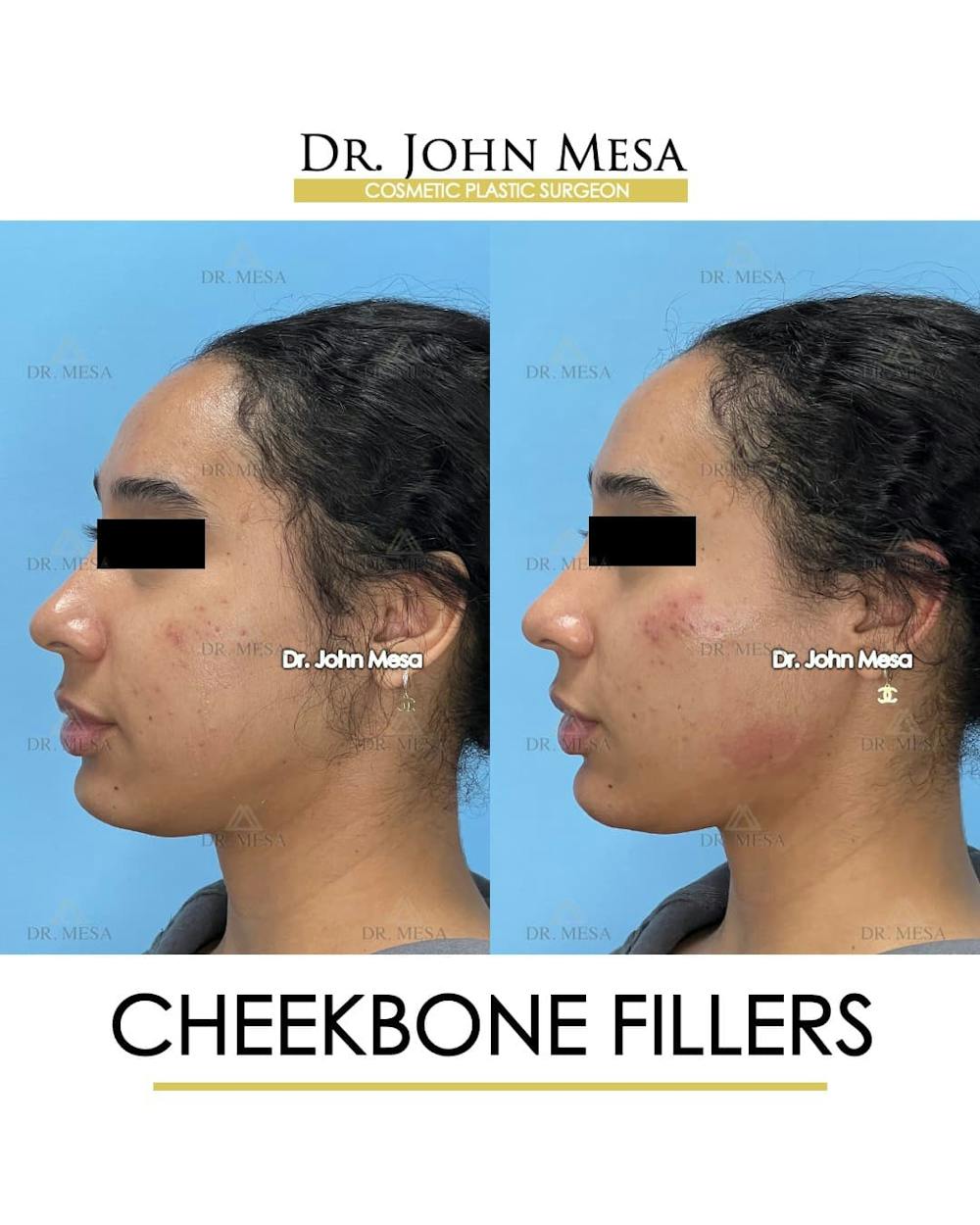 Cheekbone Filler Before & After Gallery - Patient 147931 - Image 5