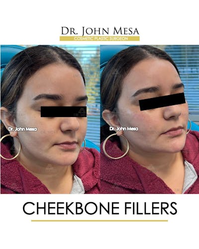 Cheekbone Filler Before & After Gallery - Patient 144967 - Image 2
