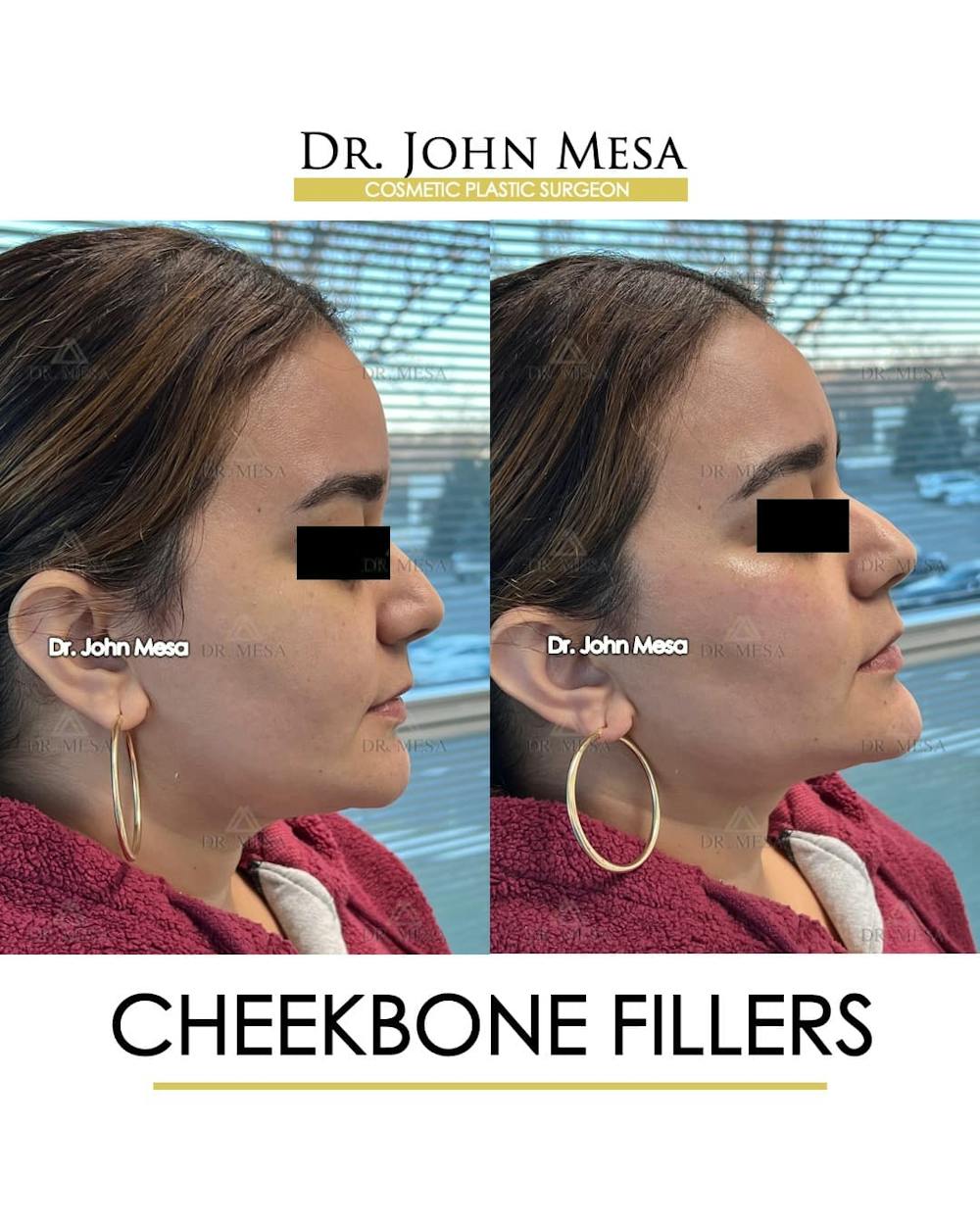 Cheekbone Filler Before & After Gallery - Patient 144967 - Image 3
