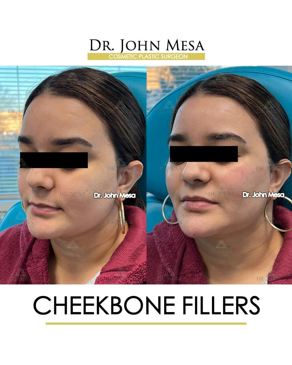 Cheekbone Filler Before & After Gallery - Patient 144967 - Image 4