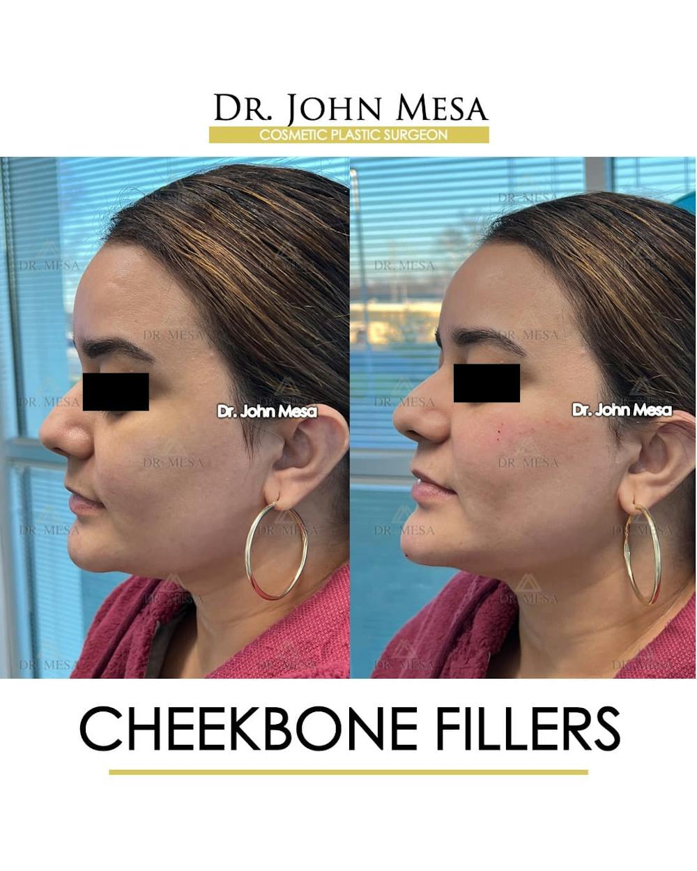 Cheekbone Filler Before & After Gallery - Patient 144967 - Image 5