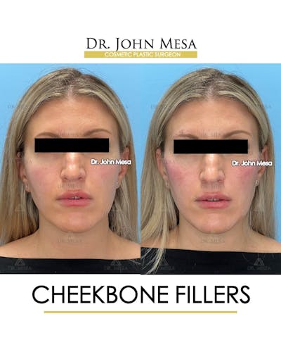 Cheekbone Filler Before & After Gallery - Patient 113649 - Image 1