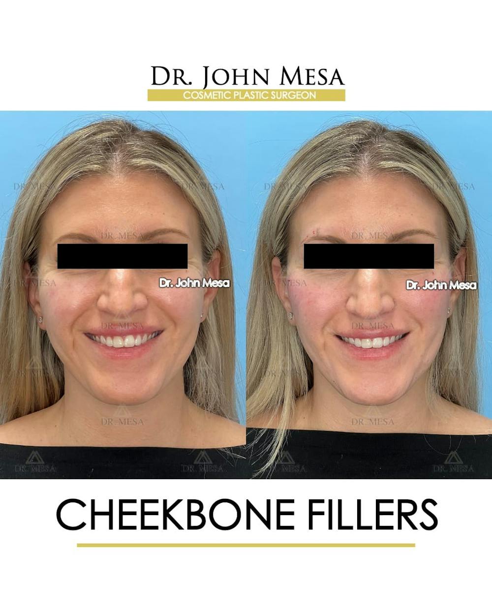 Cheekbone Filler Before & After Gallery - Patient 113649 - Image 2