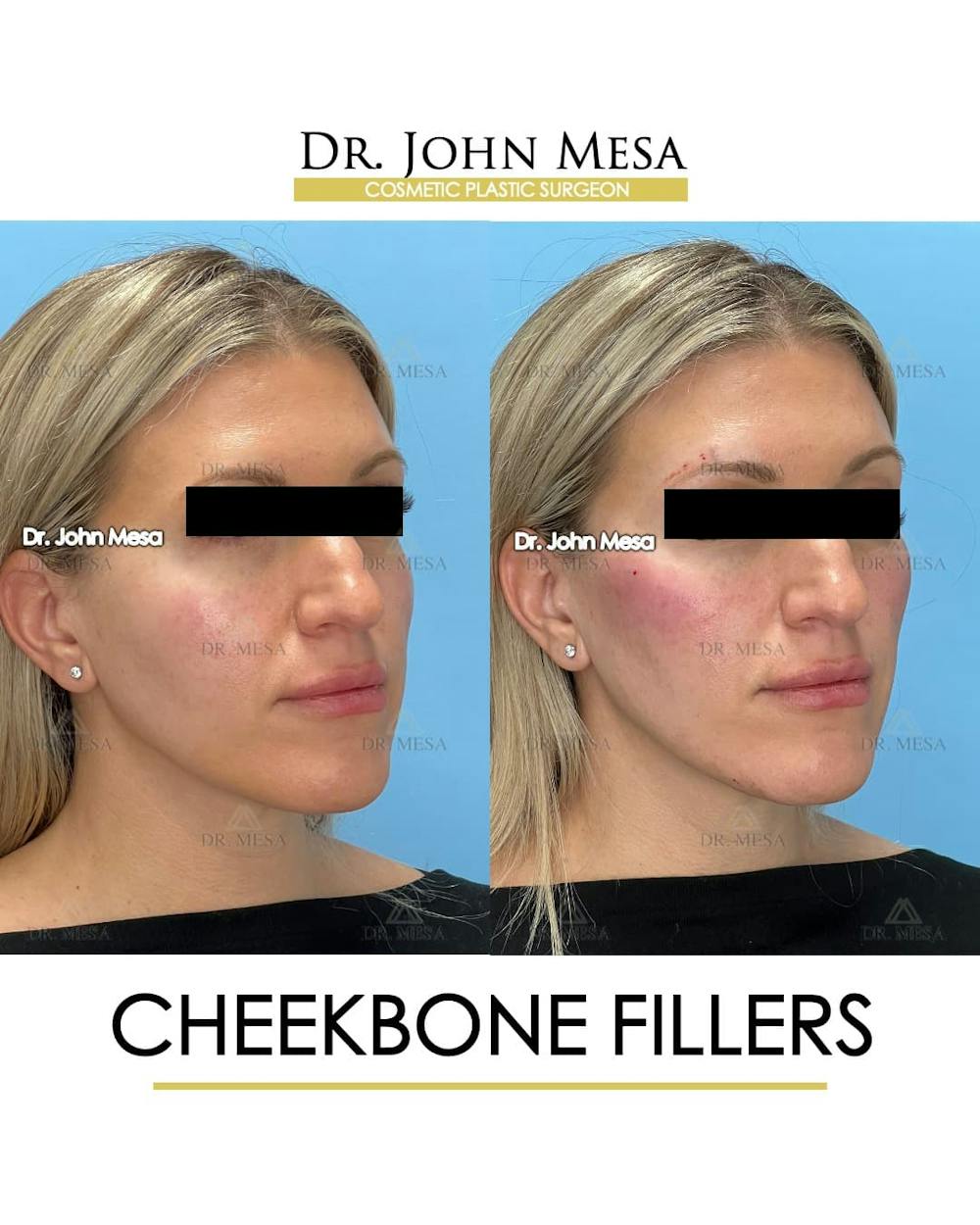 Cheekbone Filler Before & After Gallery - Patient 113649 - Image 3