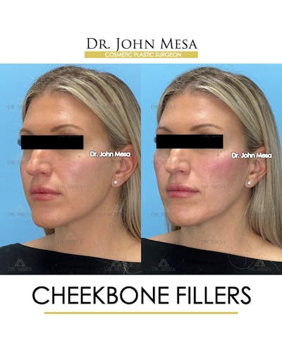 Cheekbone Filler Before & After Gallery - Patient 113649 - Image 4