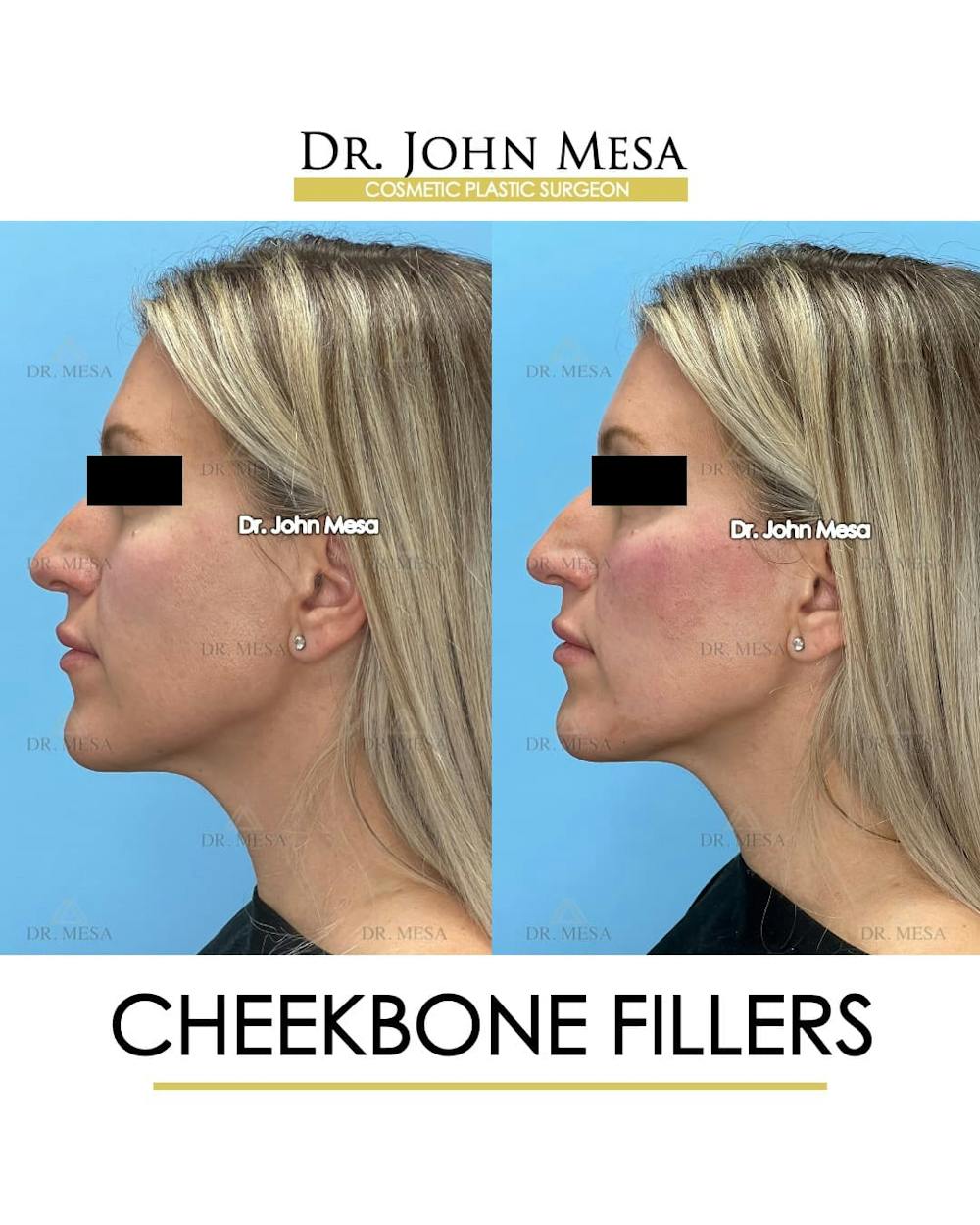 Cheekbone Filler Before & After Gallery - Patient 113649 - Image 5