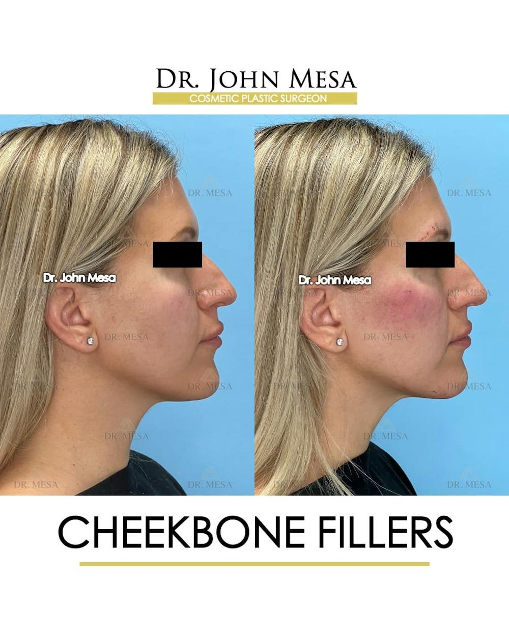 Cheekbone Filler Before & After Gallery - Patient 113649 - Image 6