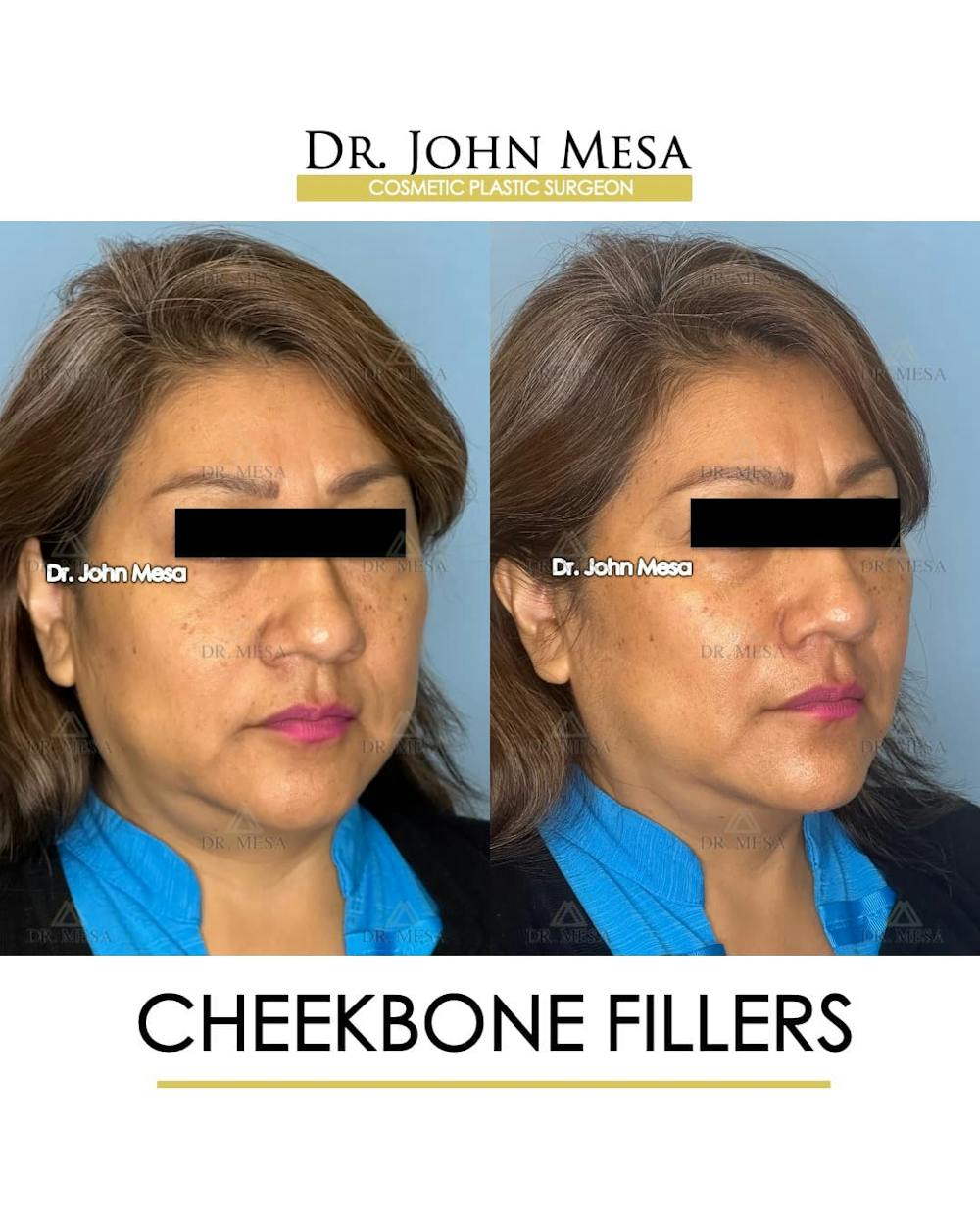 Cheekbone Filler Before & After Gallery - Patient 395722 - Image 2
