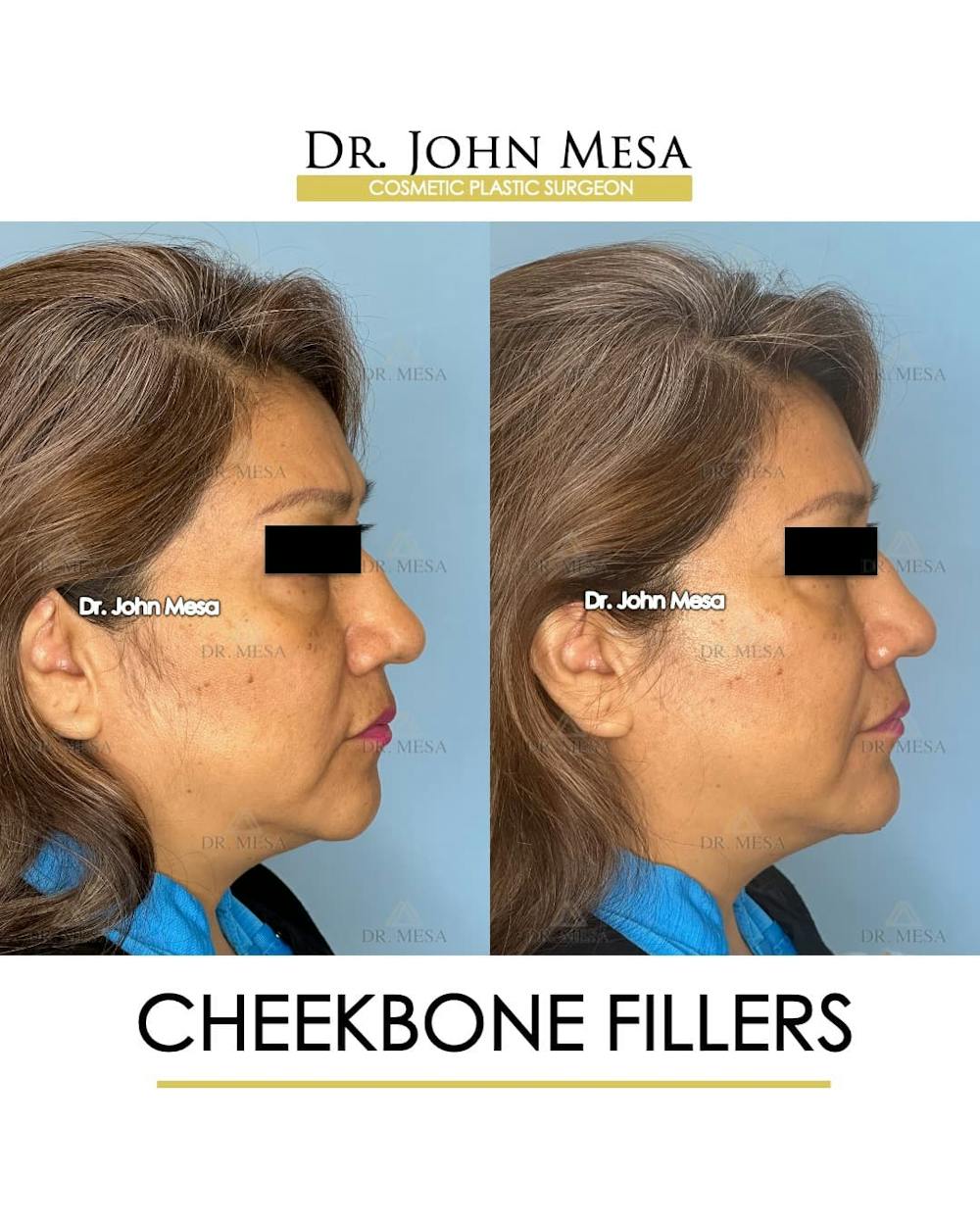Cheekbone Filler Before & After Gallery - Patient 395722 - Image 3