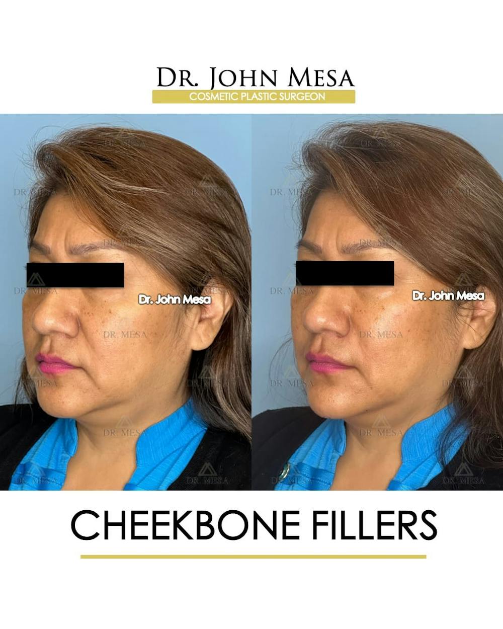 Cheekbone Filler Before & After Gallery - Patient 395722 - Image 4