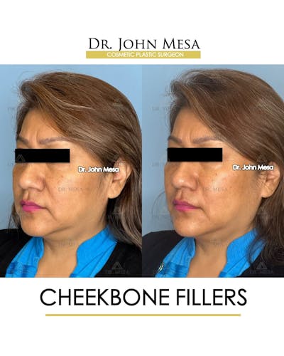Cheekbone Filler Before & After Gallery - Patient 395722 - Image 4