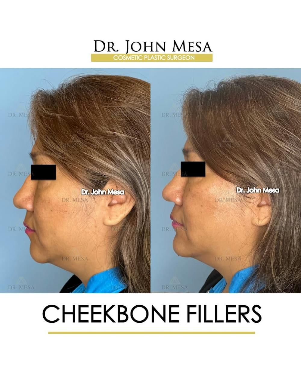 Cheekbone Filler Before & After Gallery - Patient 395722 - Image 5