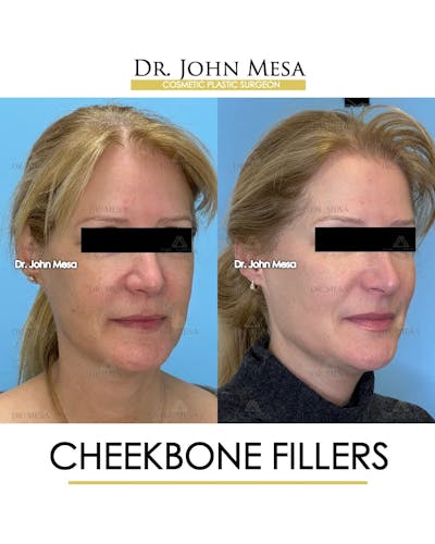 Cheekbone Filler Before & After Gallery - Patient 358911 - Image 2