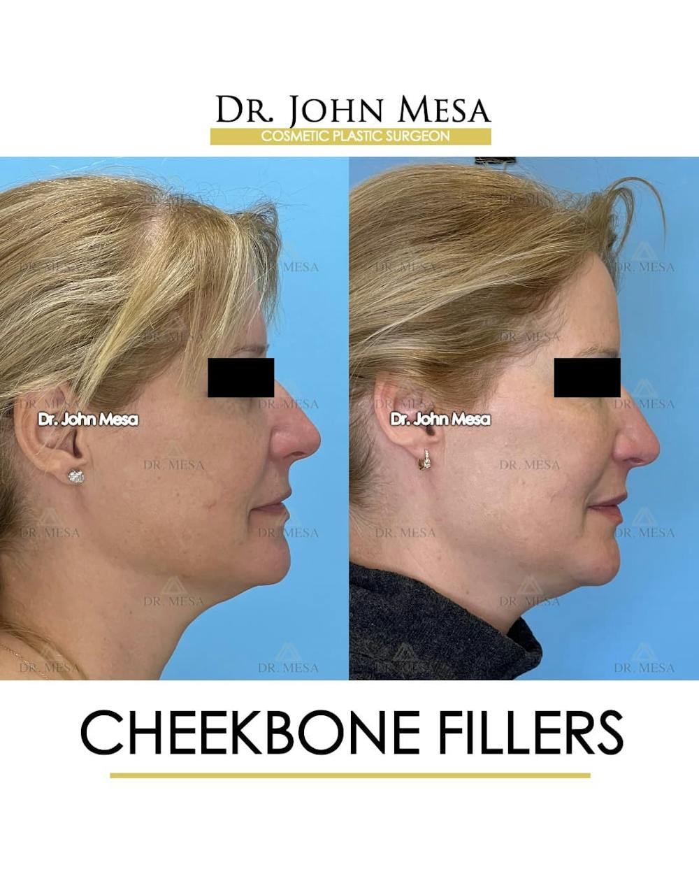 Cheekbone Filler Before & After Gallery - Patient 358911 - Image 3