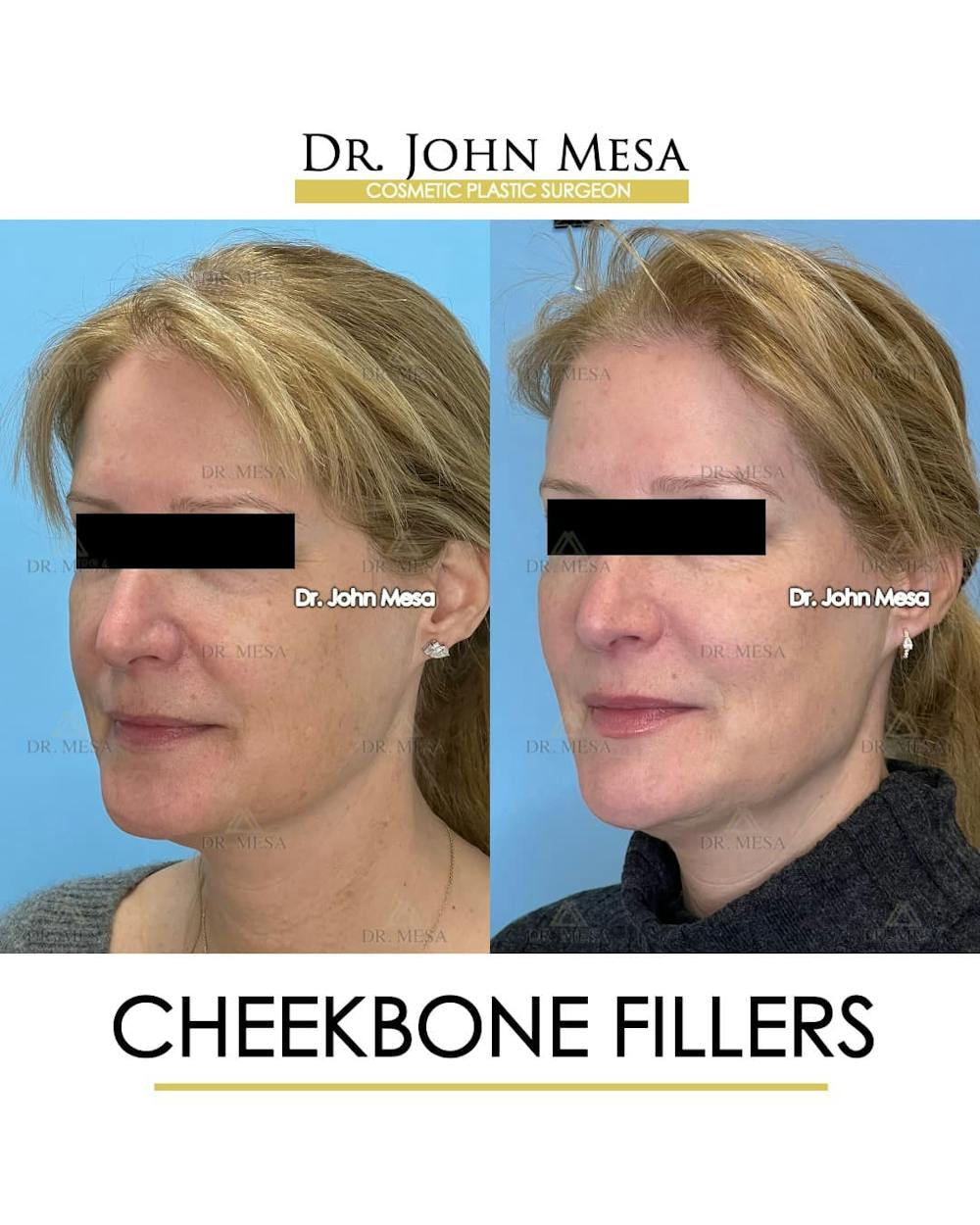 Cheekbone Filler Before & After Gallery - Patient 358911 - Image 4