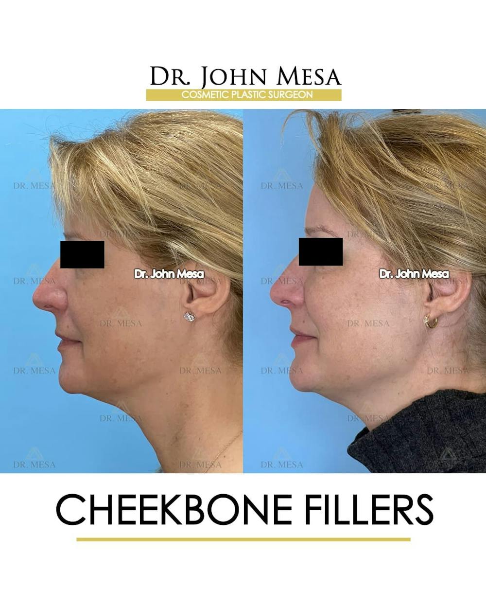 Cheekbone Filler Before & After Gallery - Patient 358911 - Image 5