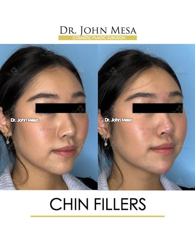 Chin Filler Before & After Gallery - Patient 266738 - Image 1