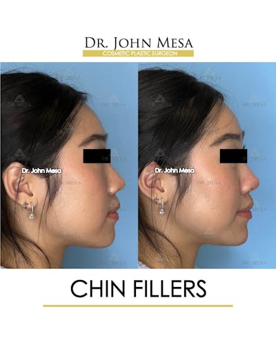 Chin Filler Before & After Gallery - Patient 266738 - Image 2