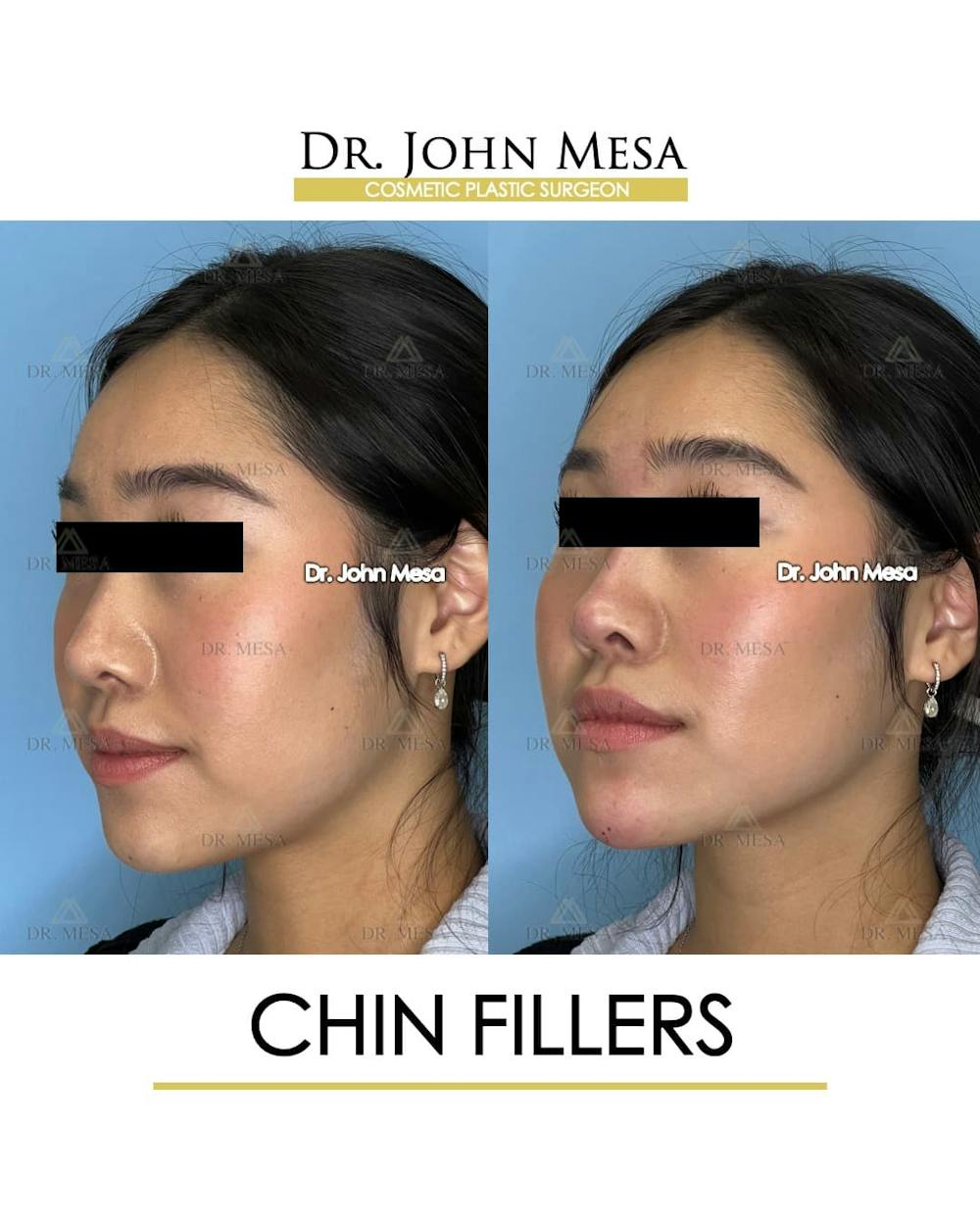 Chin Filler Before & After Gallery - Patient 266738 - Image 3