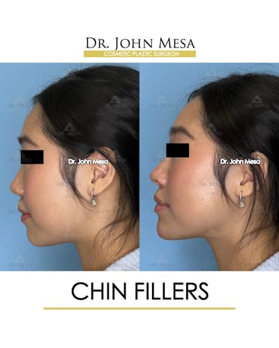 Chin Filler Before & After Gallery - Patient 266738 - Image 4