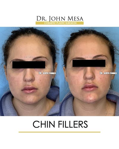 Chin Filler Before & After Gallery - Patient 491875 - Image 1