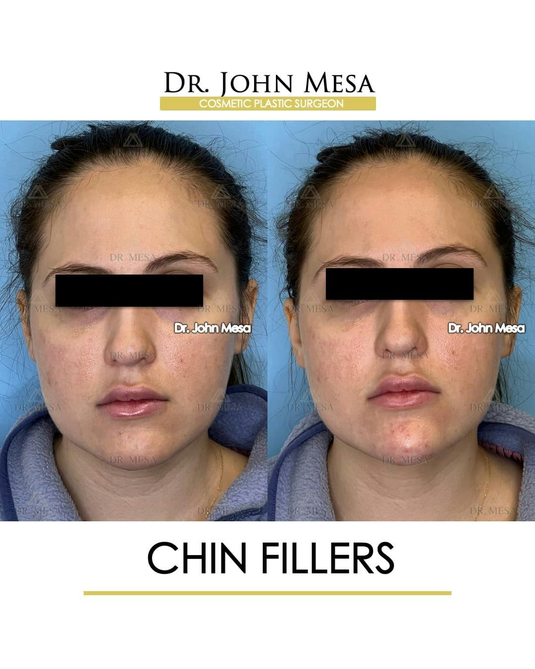 Chin Filler Before & After Gallery - Patient 491875 - Image 1