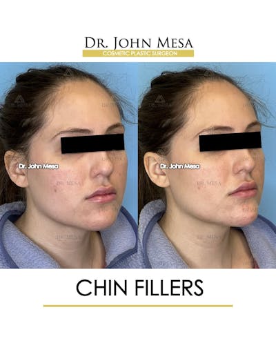 Chin Filler Before & After Gallery - Patient 491875 - Image 2