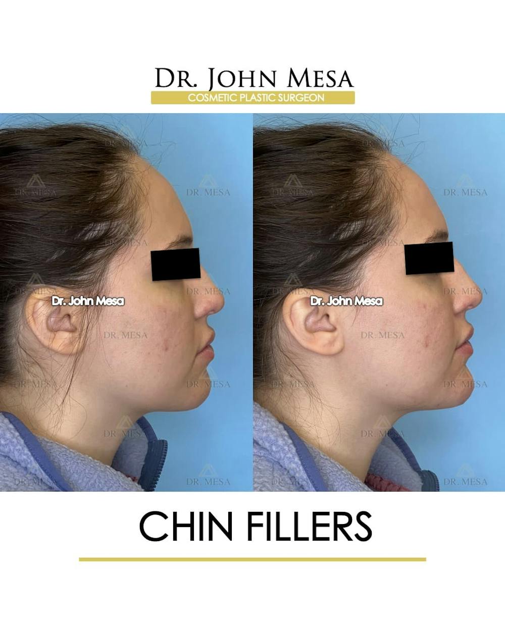 Chin Filler Before & After Gallery - Patient 491875 - Image 3